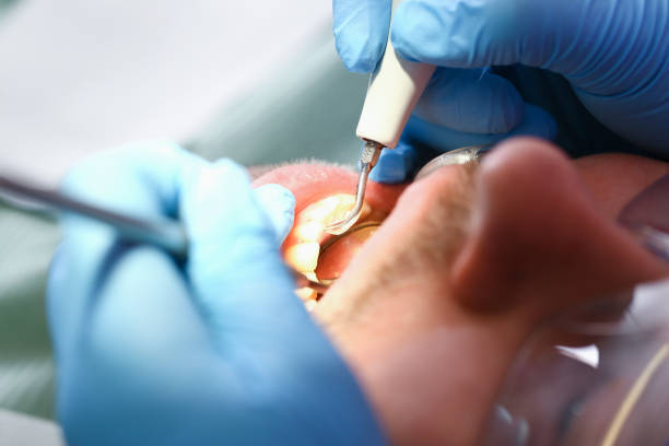 Best Emergency Tooth Extraction in Catoosa, OK